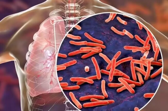 India’s TB Fight Gets Fresh Push as Centre Expands Screening, Nutrition and Treatment Tracking