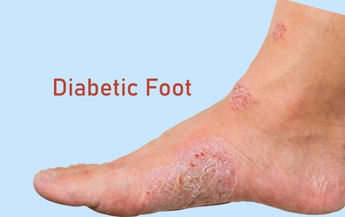 Diabetic Foot Ulcers Can Be Painless Yet Lead to Limb Loss, Warn Doctors
