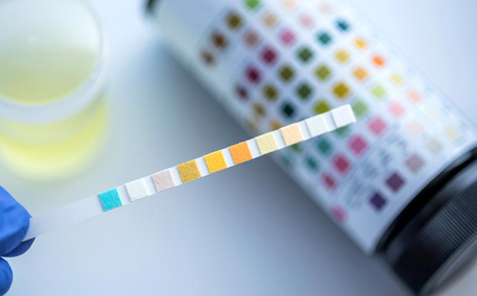 New Urine Test Shows 92% Accuracy in Detecting Bladder Cancer, Study Finds