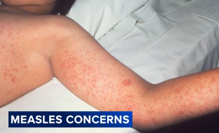 Measles Outbreak Claims Another Life in Pennsylvania