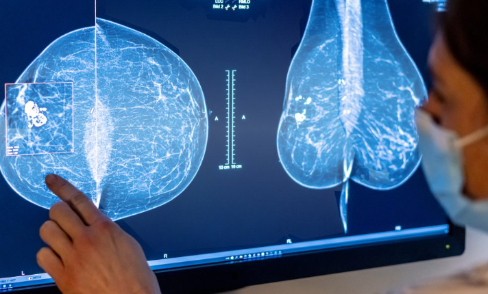 AI-Based Mammography Technology Moves Closer to Wider Use in India
